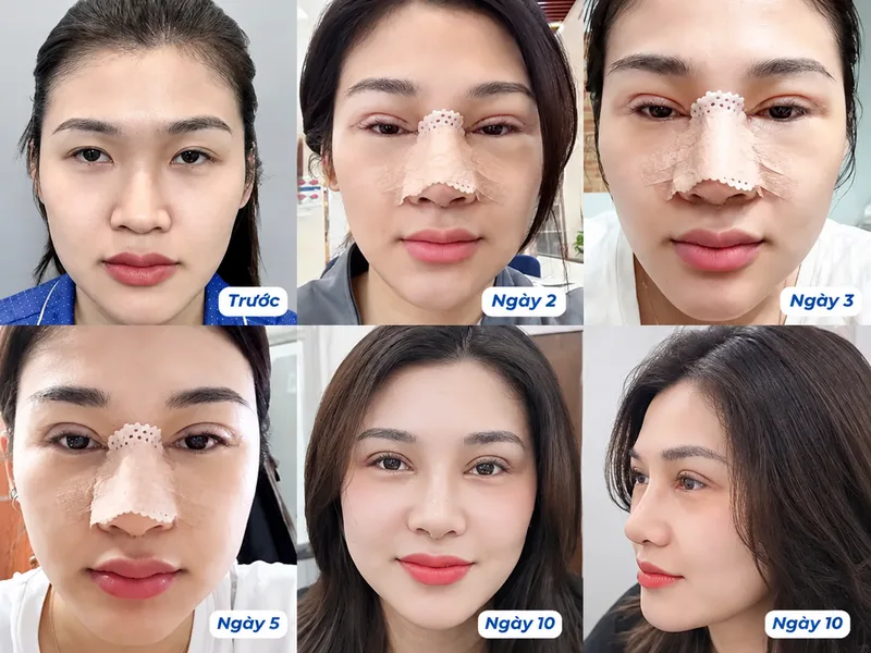 Chăm sóc đúng cách trước và sau nâng mũi giúp hỗ trợ quá trình hồi phục hiệu quả hơn.